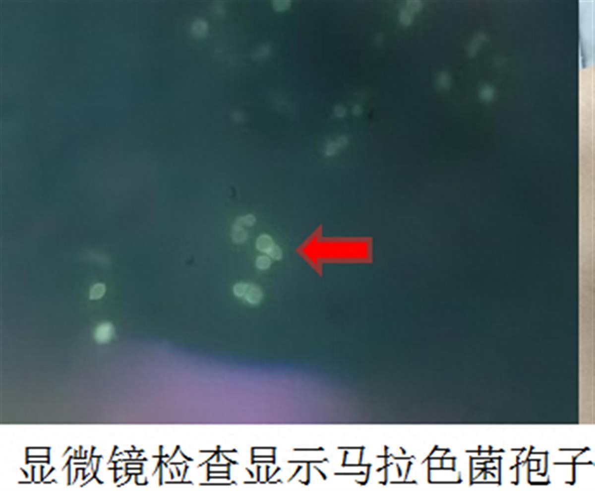 开·云体育app下载安装 15岁少年前胸后背长痘，当心这种皮肤病