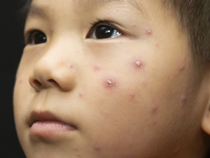 kiayun手机版登录.v1008.点进白给你1888.中国 水痘导致女性不孕