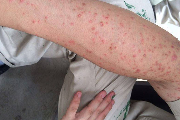 kiayun手机版登录app游戏登录入口.手机端安装.cc 艾滋病发出的第一个信号，往往在皮肤上？皮肤出现这些症状要注意