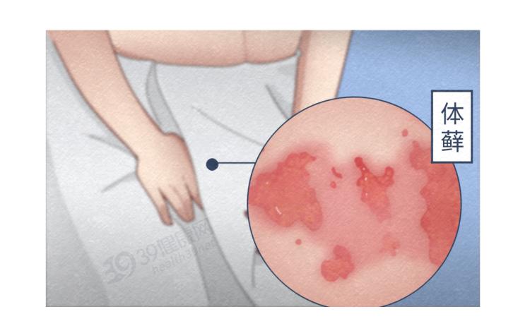 艾滋病皮肤症状_艾滋病皮疹特点_艾滋病 长痘