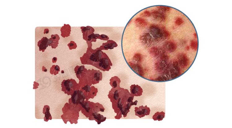 艾滋病皮疹特点_艾滋病 长痘_艾滋病皮肤症状